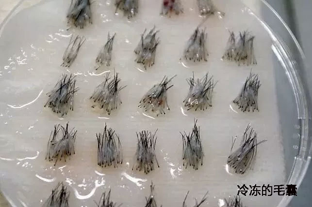 想拯救发际线？ 将毛囊冷冻起来留待之后植发用