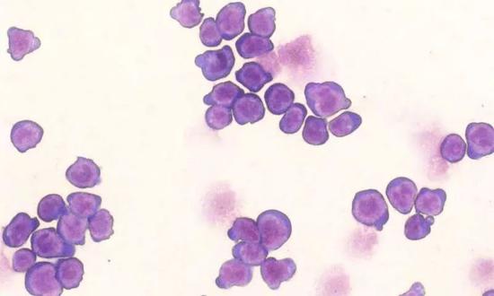 血癌患者的曙光来了！ 科学家发现改善骨髓增生