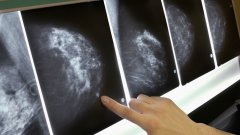       乳腺癌免疫疗法获FDA批准 国内患者有望在下