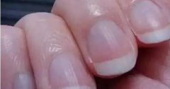指甲上有竖纹是身体有大病的征兆吗 蚂蚁庄园今