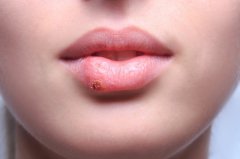 冬天嘴唇容易脱皮正确的应对方法是什么 蚂蚁庄