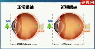 专家：近视手术无法治愈近视 近视手术到底能不