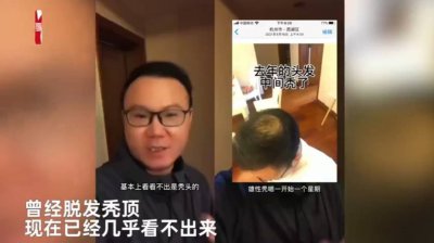 男子半年不用洗发水秃顶变满头黑发 晒视频对比