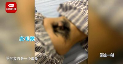 女孩染怪病后腰长出浓密毛发 医院一查……竟是