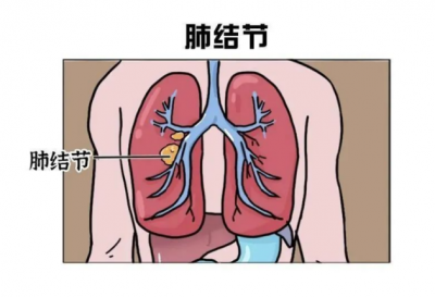 体检查出了肺结节怎么办？Fairvital的槲皮素怎么